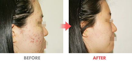 여드름 치료 전후사진