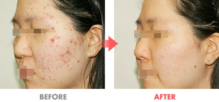 여드름 치료 전후사진