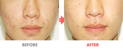 여드름 치료 전후사진