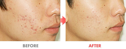 여드름 치료 전후사진