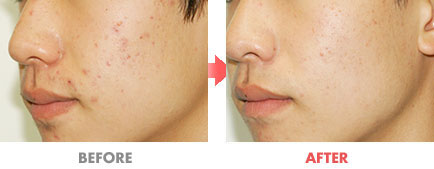 여드름 치료 전후사진